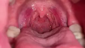 nana困薯_口腔展示